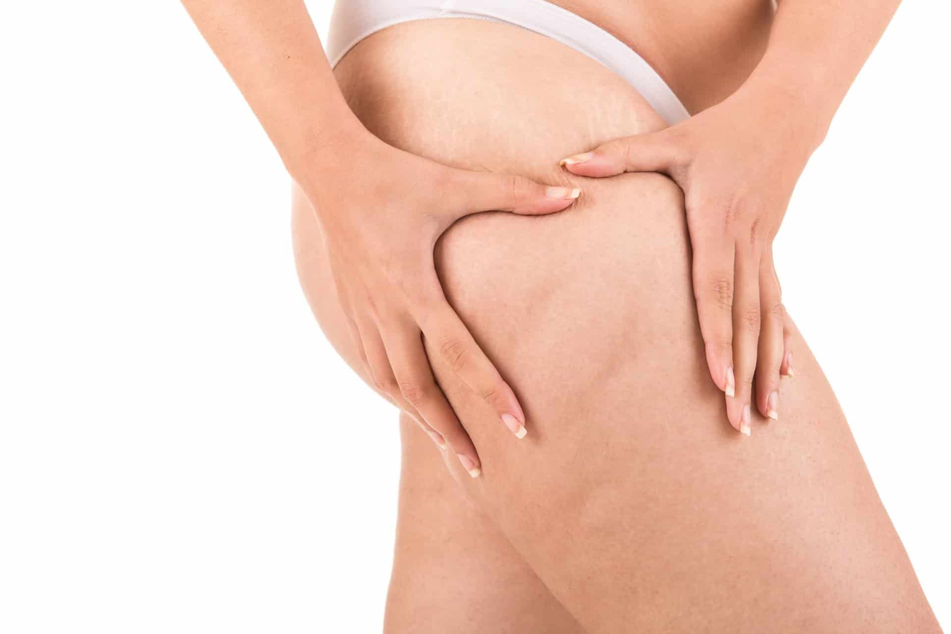 Is Cellulite Caused By Toxins?