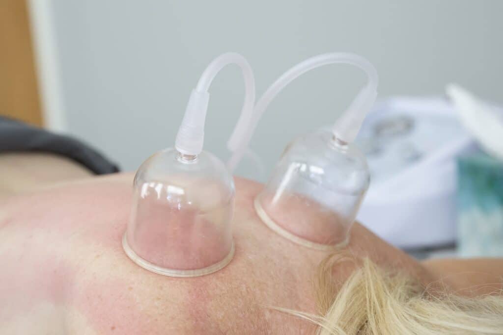 Cupping process applied along the spine