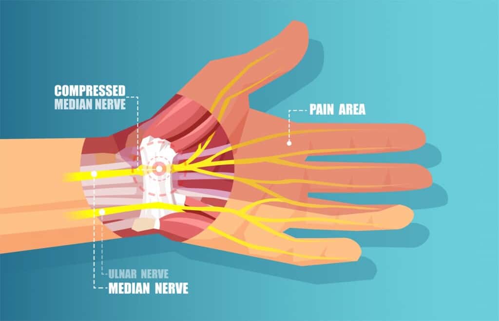 Diagram of carpal tunnel syndrome with median nerve compression