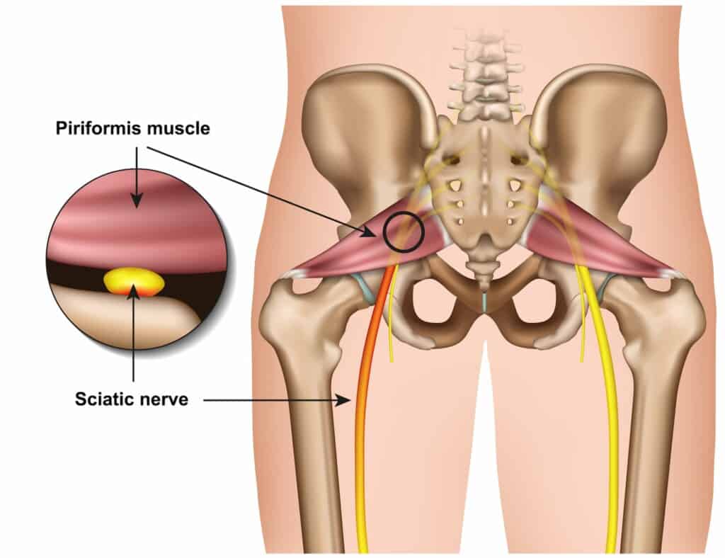 Piriformis syndrome and sciatic nerve compression pain cause outline diagram.