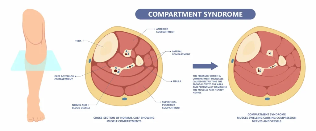 Diagram comparing cross-sections of a normal calf and a calf with compartment syndrome, where pressure blocks blood flow.