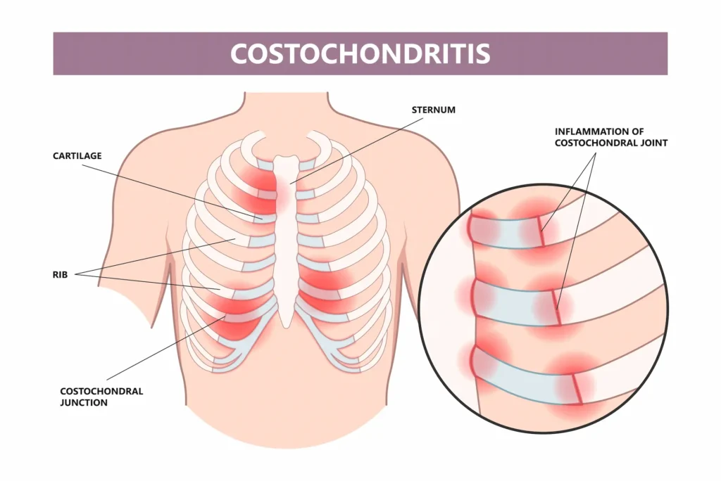 Diagram of costochondritis showing rib inflammation at the costochondral joints.