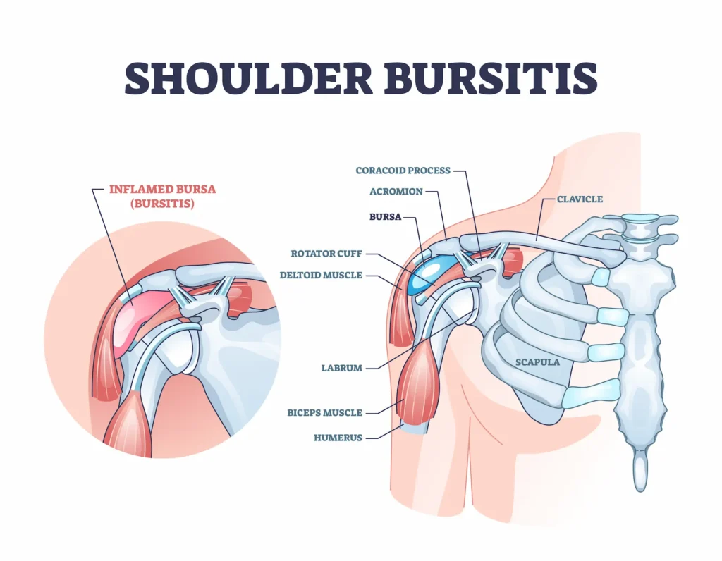 Labeled medical illustration of shoulder bursitis, showing an inflamed bursa in the shoulder joint along with surrounding muscles, bones, and structures.