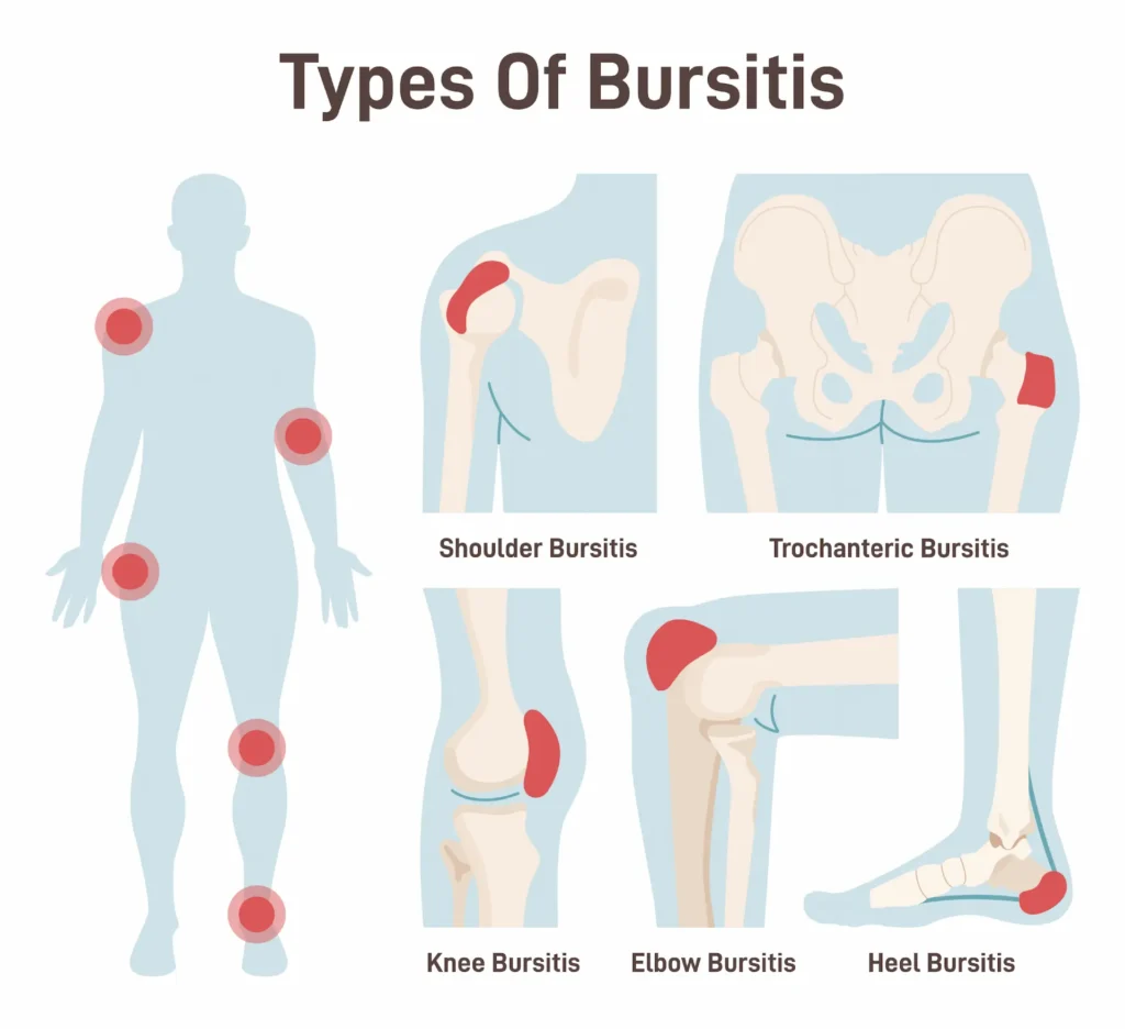 Medical diagram showing different types of bursitis, highlighting affected areas in the shoulder, hip, knee, elbow, and heel.