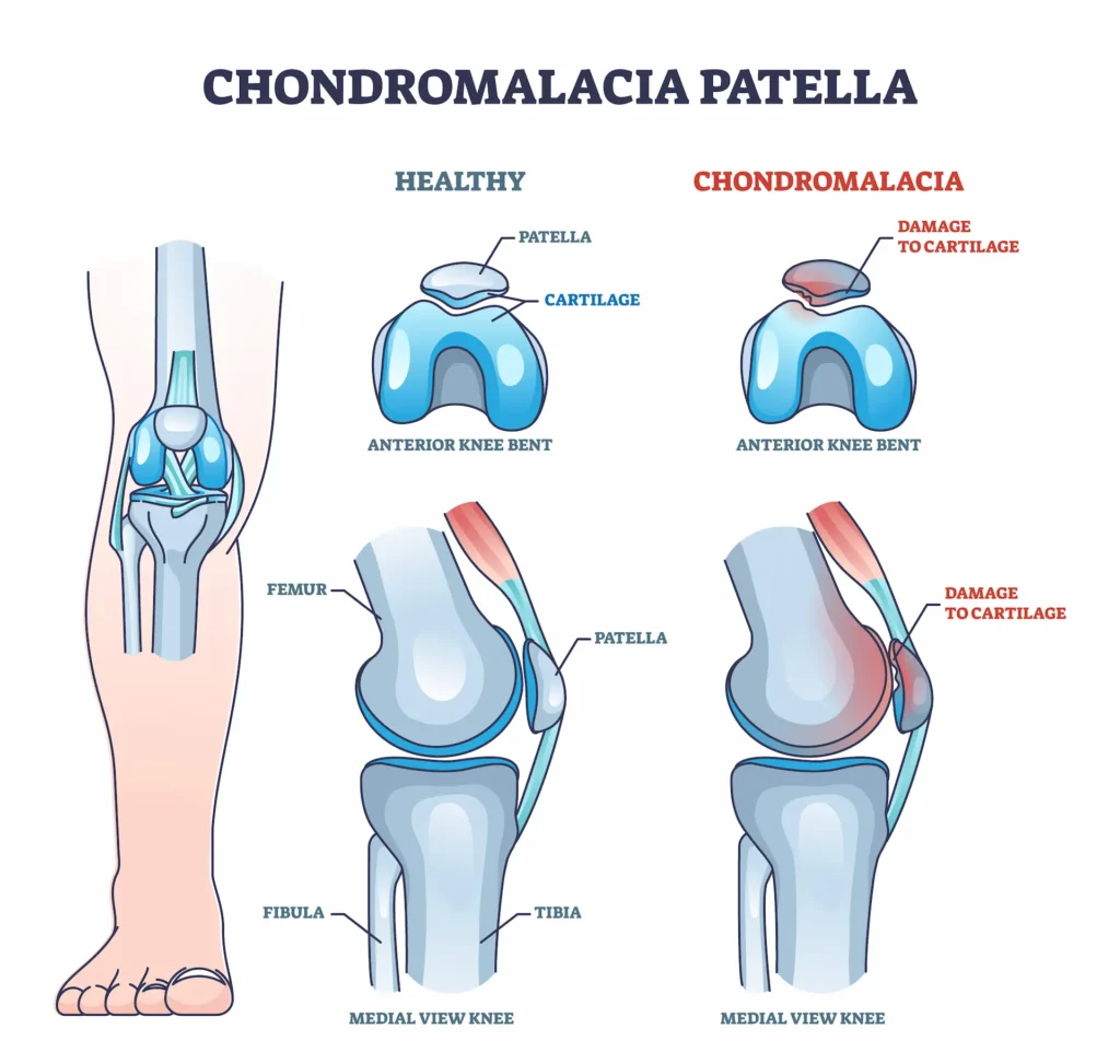 Medical illustration comparing a healthy knee joint to one with chondromalacia patella. The diagram shows damage to the cartilage behind the kneecap in both anterior and medial views.