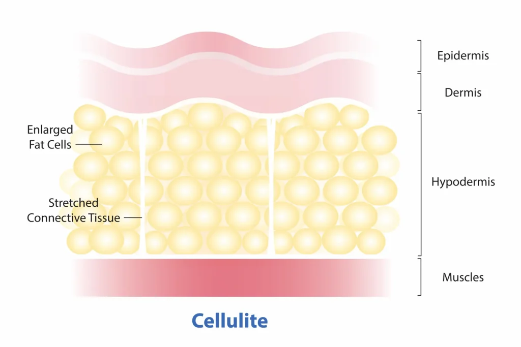 Illustration showing enlarged fat cells pressing through weakened fascia layers, causing the dimpled appearance associated with cellulite.