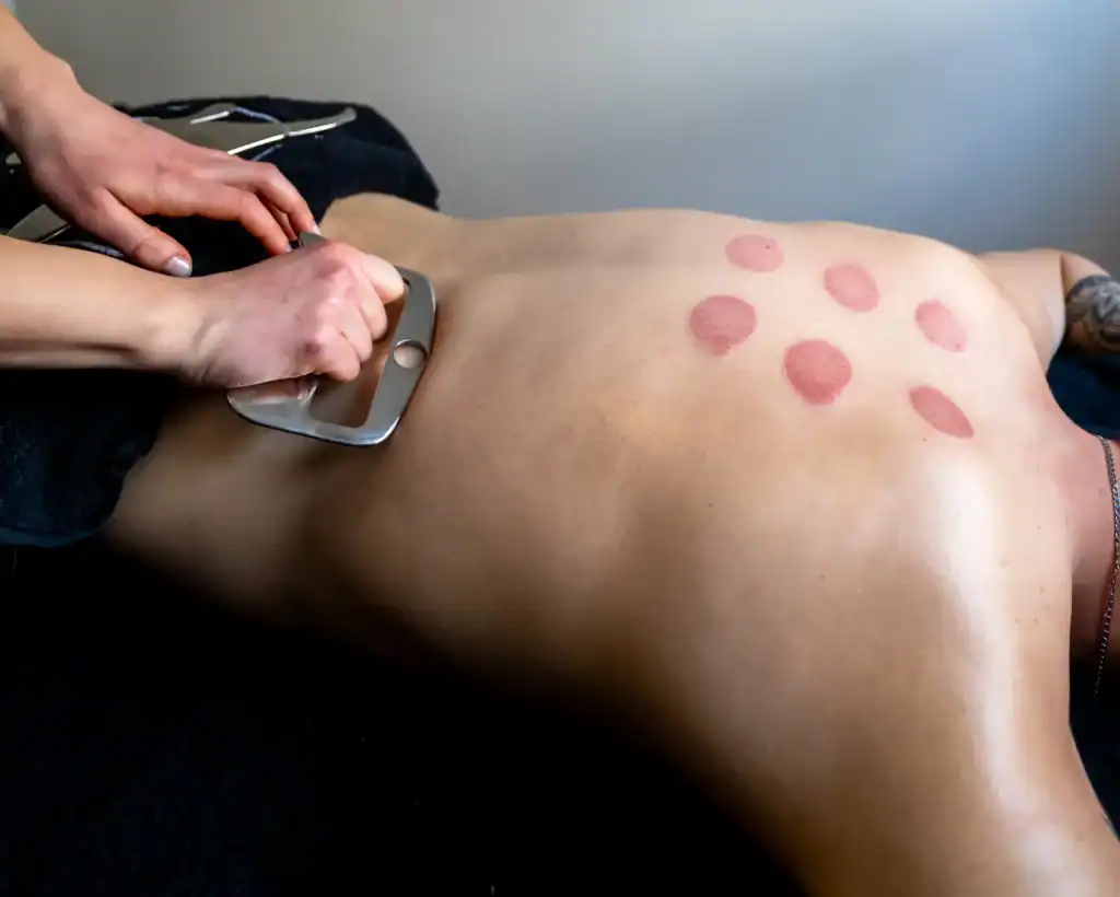 How We Use Gua Sha Massage Therapy to Break Up Pain and Restore Movement 4 Stainless steel Gua Sha tool being used on the lower back with visible cupping marks on upper back.